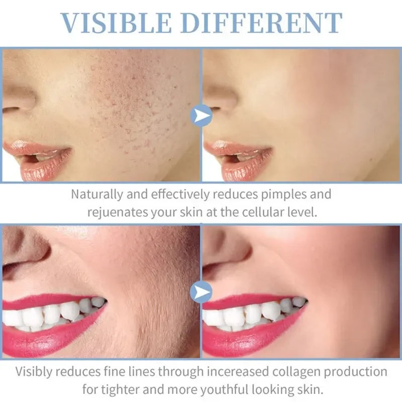 4-in-1 Portable High Frequency Facial Wand – Acne & Skin Therapy